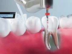 Методы и способы лечения корневых каналов зубов