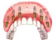 Этапы имплантации и протезирования по методике All-on-6