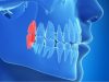 Зубы мудрости: показания к удалению