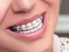 Установка брекетов на зубы — подготовка, этапы, уход