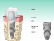 Лучшие клиники по имплантации зубов в Москве