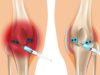 Современное лечение коленного сустава с помощью плазмолифтинга