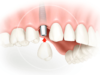 Преимущества имплантации зубов