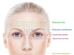 Ботулинотерапия: проведение процедуры в косметологической клинике LA7
