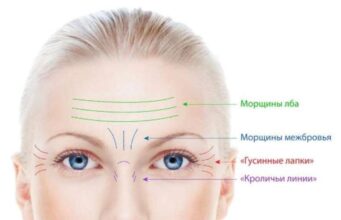Ботулинотерапия: проведение процедуры в косметологической клинике LA7