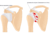 Синдром замороженного плеча: что это такое и как его вылечить