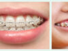 Виды брекет систем: особенности и правила выбора