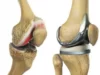 Замена коленного сустава: особенности и преимущества процедуры