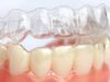 Система Лечения на Основе Элайнеров: Преимущества и Процесс Исправления Прикуса