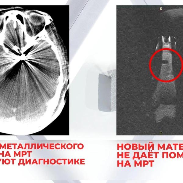 В Центре Мешалкина создали замену титану из «черного алмаза» для протезирования костей