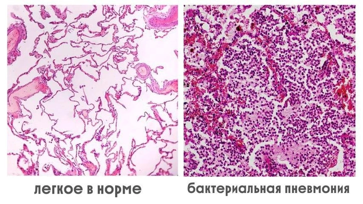 Как выглядят легкие под микроскопом при пневмонии — теперь понятно, почему так сложно дышать