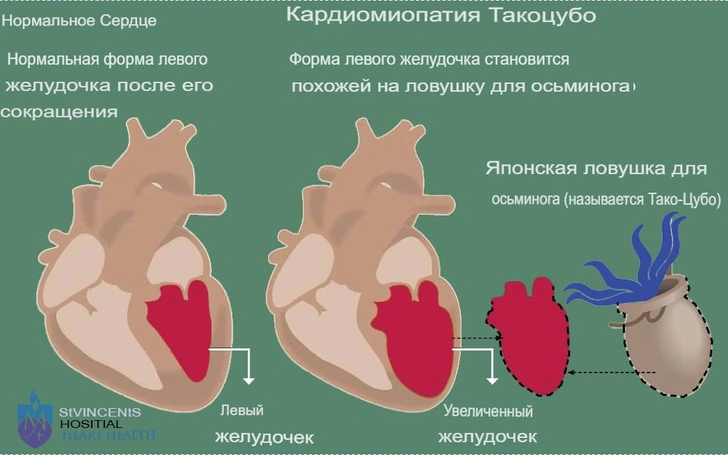 Из-за смерти любимого питомца у женщины развился синдром такоцубо