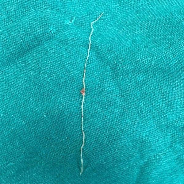 В Китае врачи удалили из кишечника мужчины зубную щетку, с которой он прожил полвека