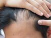 Пересадка волос: как проходит операция, методы и стоимость