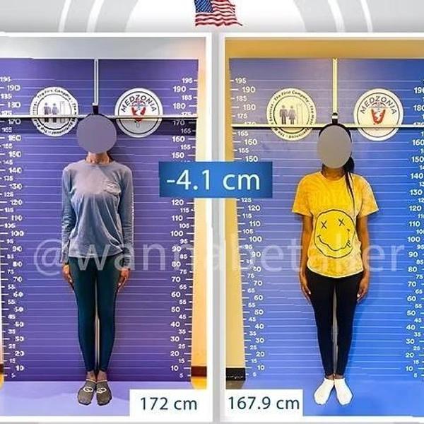 Модели больше не в моде? Зачем женщины делают операции по укорачиванию ног