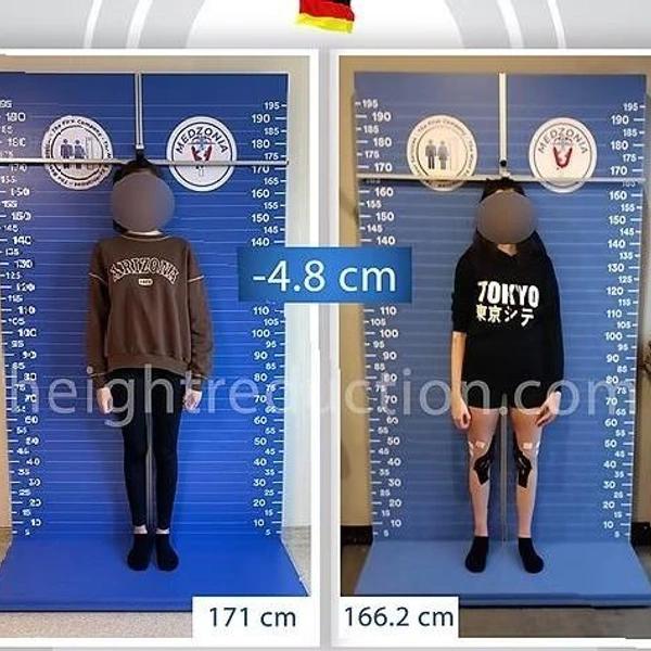 Модели больше не в моде? Зачем женщины делают операции по укорачиванию ног