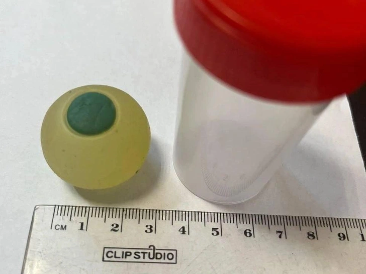 Челябинские хирурги достали из кишечника 9-летнего мальчика силиконовый глаз