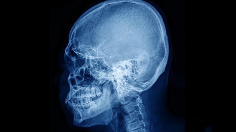 Ученые улучшили "оптическое просветление" тканей черепа