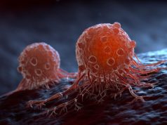 В Томске начали наблюдение за «зарождением» метастазов