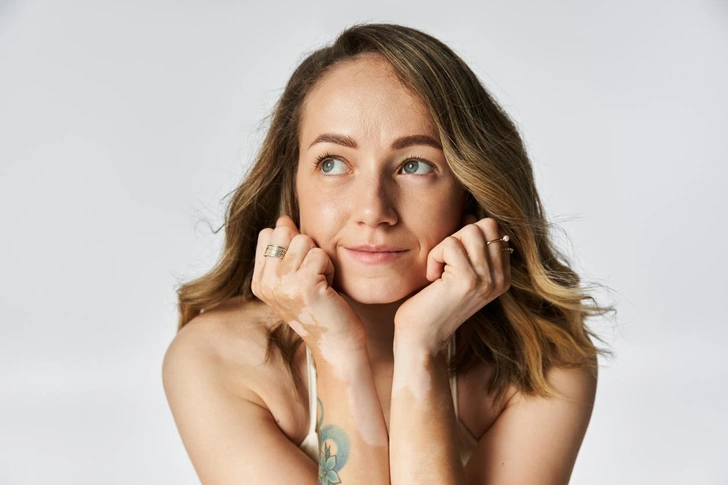 Когда кожа теряет цвет: правда о витилиго&nbsp;&mdash; болезни, от которой страдают даже знаменитости