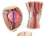 Когда колено «болит» изнутри: как лечят аневризму подколенной артерии