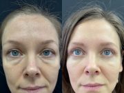 Как взгляд меняет жизнь: все, что стоит знать о блефаропластике