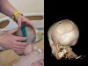 Хирурги восстановили череп 3-летней девочки, которую отец выбросил из окна четвертого этажа