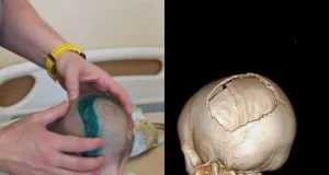 Хирурги восстановили череп 3-летней девочки, которую отец выбросил из окна четвертого этажа