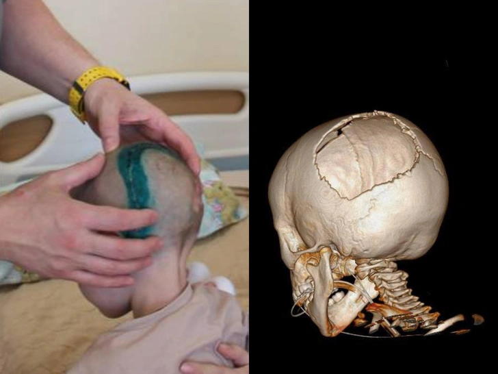 Хирурги восстановили череп 3-летней девочки, которую отец выбросил из окна четвертого этажа