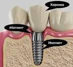 Вернуть улыбку: что действительно нужно знать об имплантации зубов
