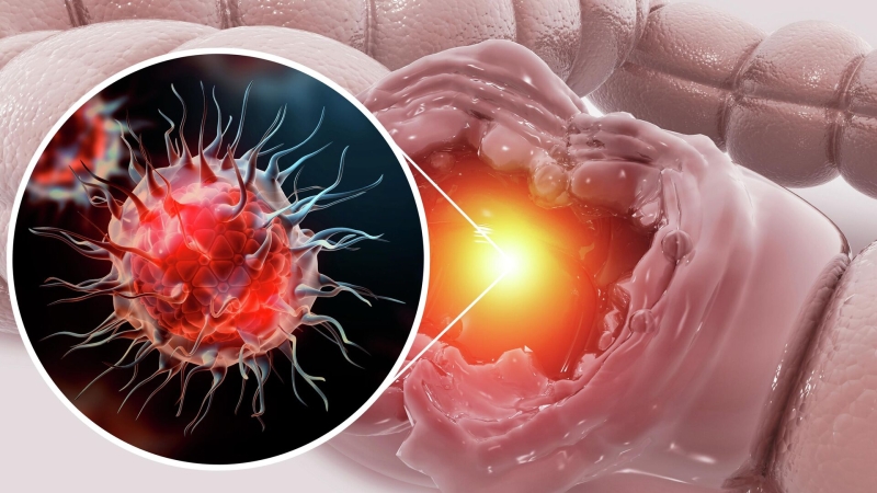 Ученые нашли путь к подавлению роста раковых клеток