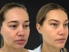 Эндолифтинг лба: что это, как действует и стоит ли пробовать