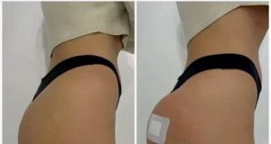 Увеличение ягодиц полимолочной кислотой в клинике Алтеро