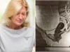 Как восемь полторашек: врачи удалили у женщины кисту с 12 литрами жидкости