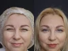 Иньекции ботокса: честно о том, что изменяет лицо и настроение