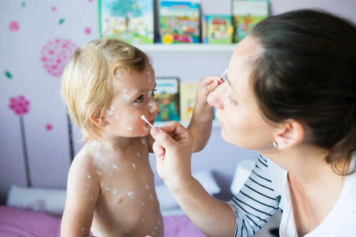 У 4-летней девочки случился инсульт, который спровоцировала ветрянка