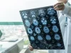 Ученые изобрели гель, создающий нейроны взамен утраченных при болезни Альцгеймера