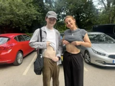 24-летняя девушка пожертвовала почку брату с редким синдромом Альпорта